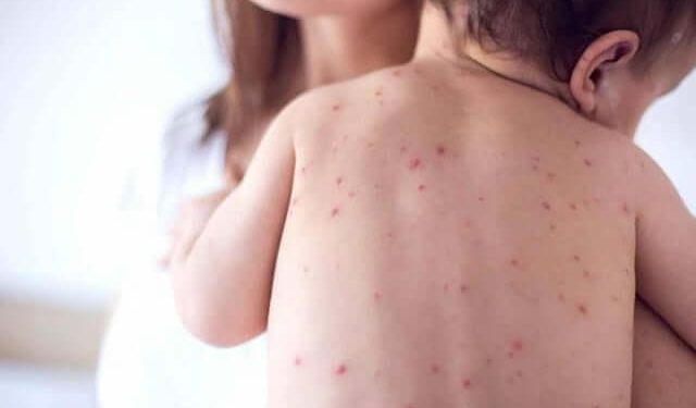 Հայաստանում կարմրուկի դեպքերի աճ է նկատվում. ԱՆ