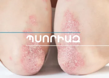Կարող է լուրջ ազդեցություն ունենալ կյանքի որակի վրա, չի փոխանցվում շփման միջոցով. օգոստոսը Պսորիազի իրազեկման ամիս է