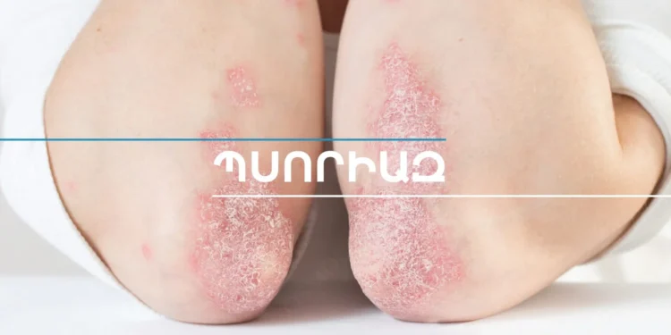 Կարող է լուրջ ազդեցություն ունենալ կյանքի որակի վրա, չի փոխանցվում շփման միջոցով. օգոստոսը Պսորիազի իրազեկման ամիս է