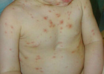 Օգոստոսի 1-20-ն ընկած ժամանակահատվածում ջրծաղիկի 336 դեպք է գրանցվել