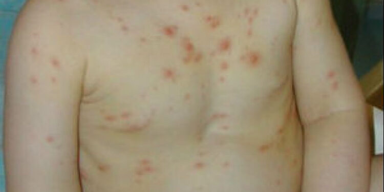 Օգոստոսի 1-20-ն ընկած ժամանակահատվածում ջրծաղիկի 336 դեպք է գրանցվել