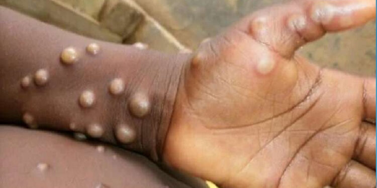 Հայաստանում կապիկի ծաղիկ հիվանդության դեպք չի գրանցվել. ԱՆ