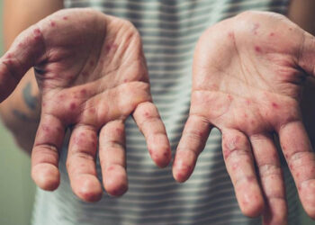 Հայաստանում արձանագրվում է կարմրուկով և կապույտ հազով հիվանդացության դեպքերի աճ