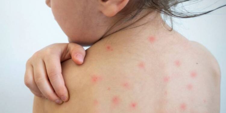 Կարմրուկի 543 դեպք է գրանցվել. 2-ը հոսպիտալացված են