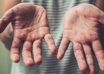 Կարմրուկի համաճարակային իրավիճակը կարող է սրվել՝ զբոսաշրջության ակտիվությամբ պայմանավորված. ԱՆ