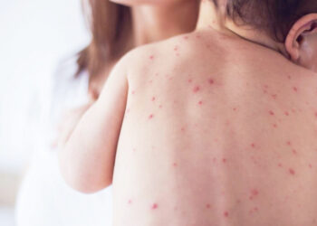 2024-ին Հայաստանում կարմրուկով վարակման 553 դեպք է գրանցվել