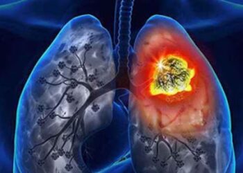 Տարեկան շուրջ 3 մլն մարդ  մահանում է թոքերի քրոնիկ օբստրուկտիվ հիվանդությունից. ինչպե՞ս այն կանխարգելել