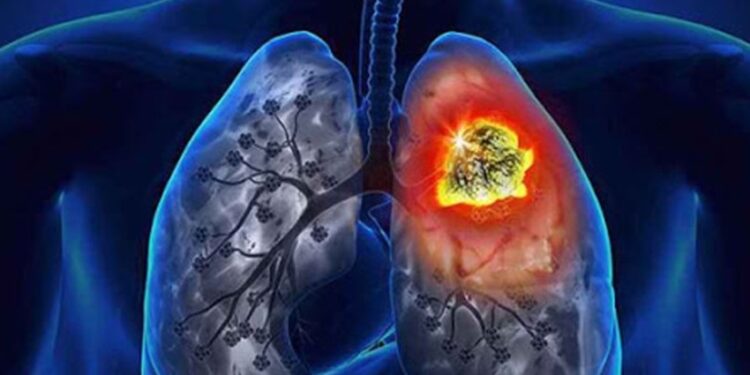 Տարեկան շուրջ 3 մլն մարդ մահանում է թոքերի քրոնիկ օբստրուկտիվ հիվանդությունից. ինչպե՞ս այն կանխարգելել